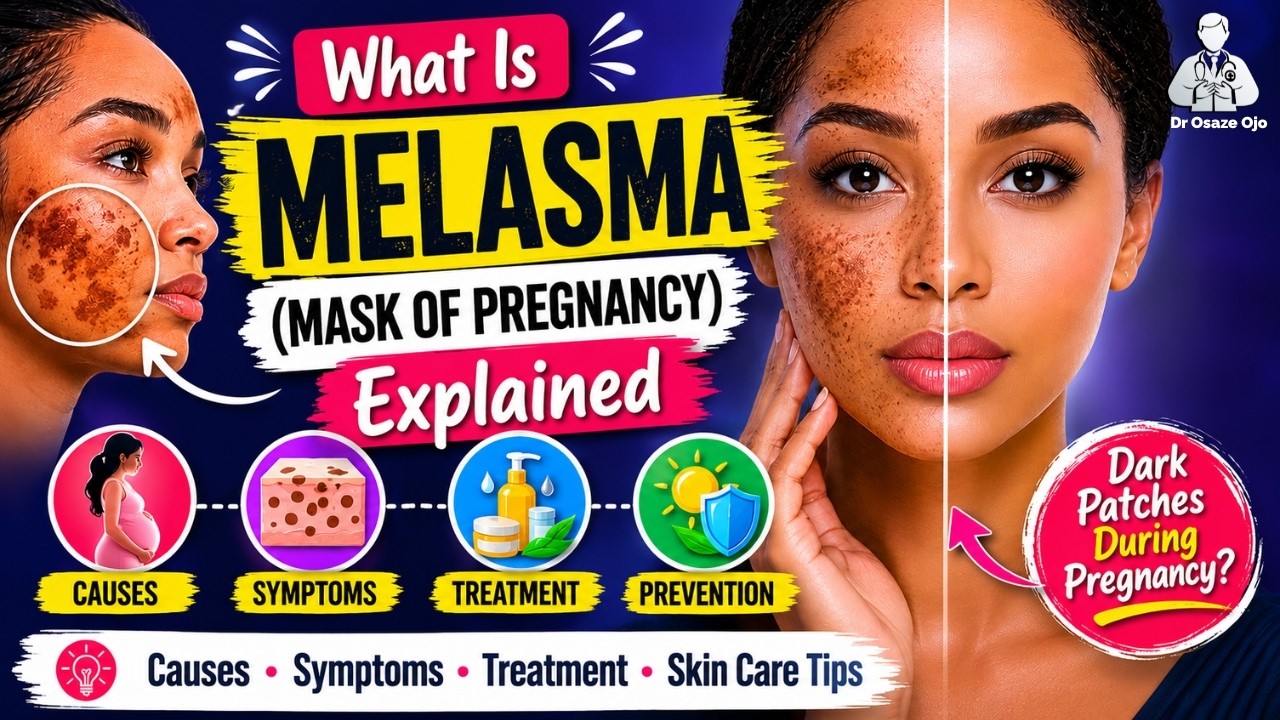 What Is Melasma (Mask of Pregnancy) — Causes, Symptoms, Treatment